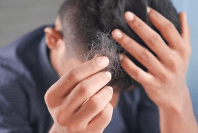 원형탈모 증상